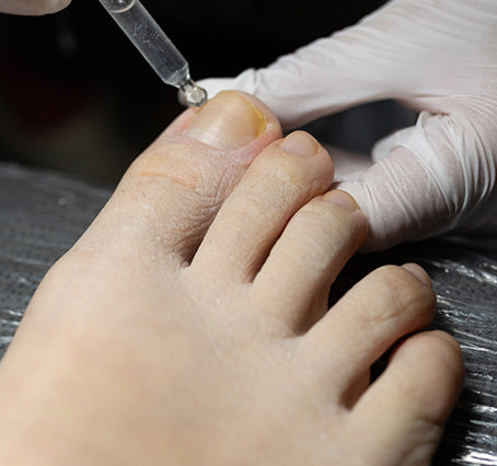 Toe Fungus Removal (FOOT / per TOE)
